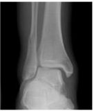 Ankle fractures - JUNIORBONES